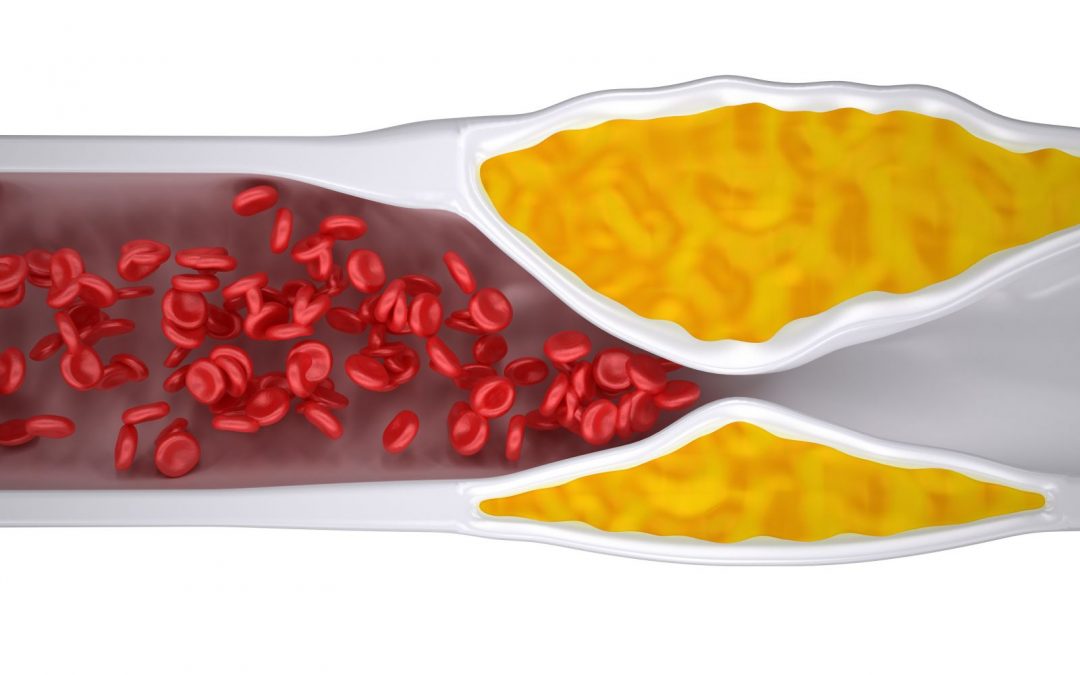 An insight about Clogged arteries and how alternative methods help